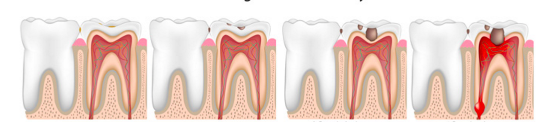 مراحل تسوس الأسنان