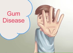 التهاب اللثة