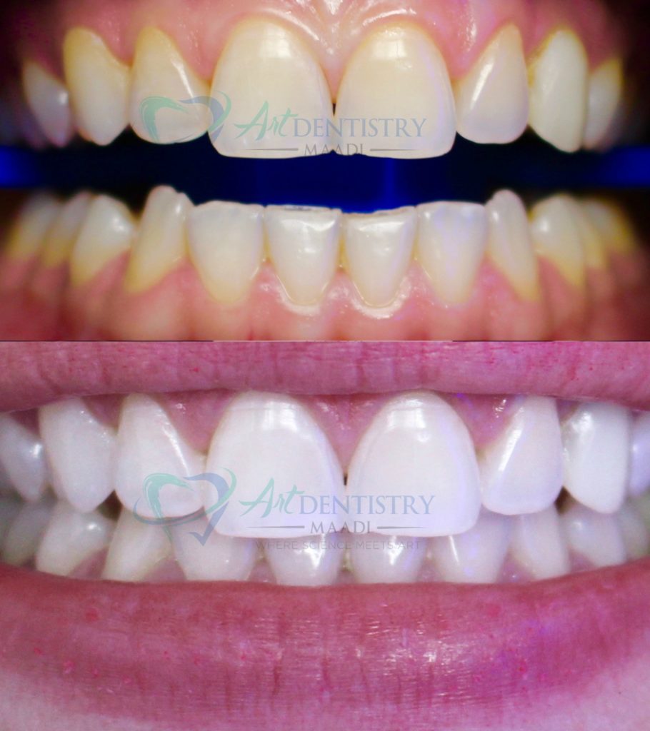 zoom teeth whitening in maadiتبييض أسنان في المعادي