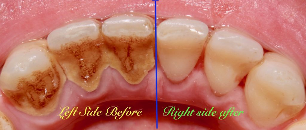 Teeth having calculus and plaque before and after dental cleaning