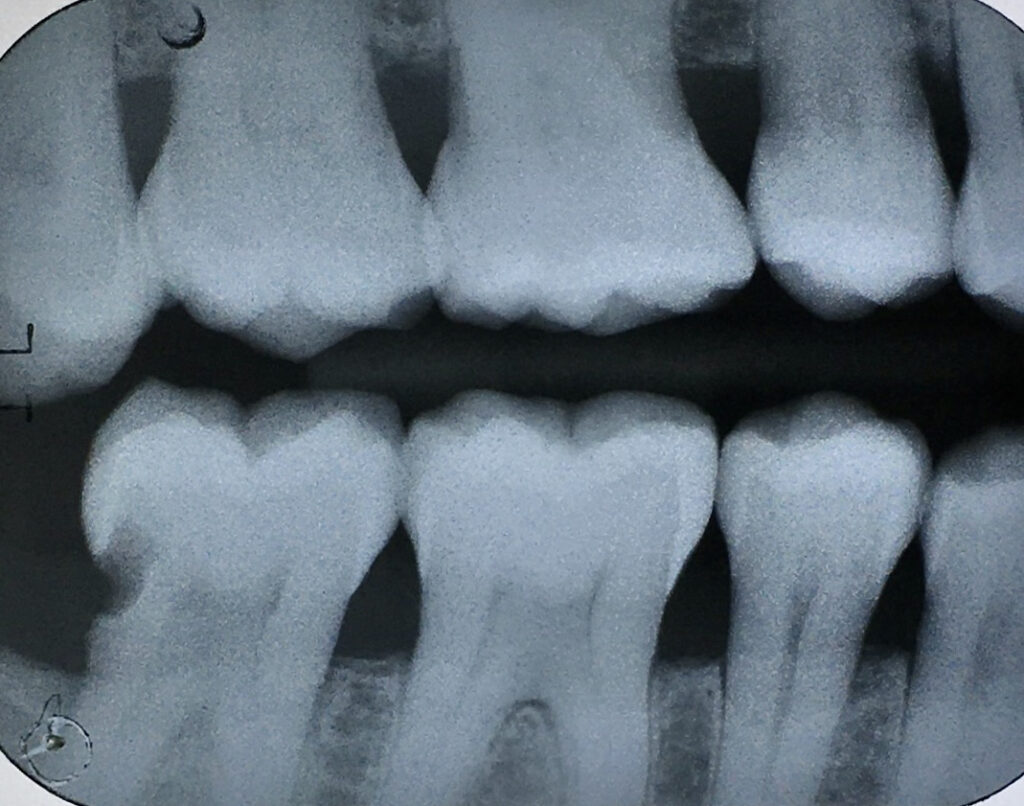 Right horizontal bitewing after calculus removal