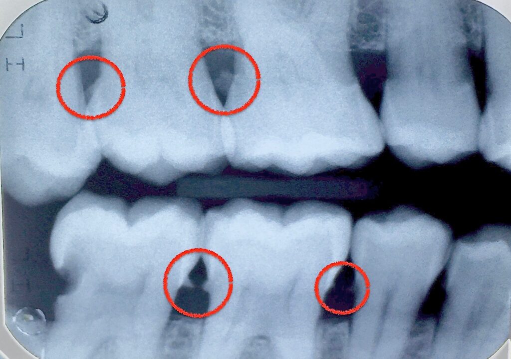 Right horizontal bitewing X-ray showing calculus